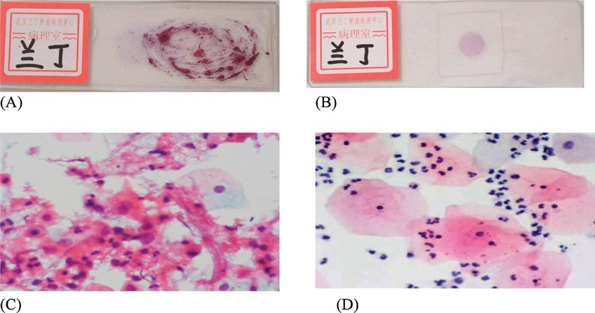 Lbc Scan Liquid Based Cytology (LBC): Definition and Advantages – Innovative ...