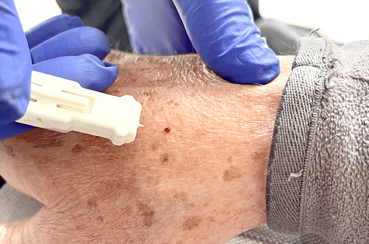 Harpera™ tool for skin Microsampling or Biopsy