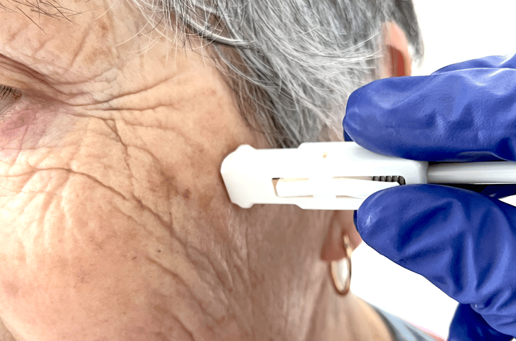 Harpera™ tool for skin Microsampling or Biopsy